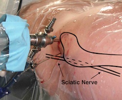 Hip Scope Nerves at Risk 2